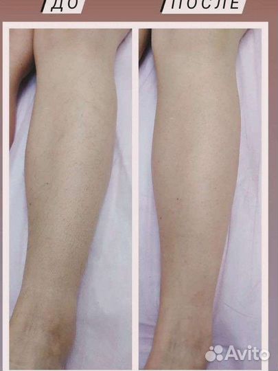 Шугаринг в Судаке