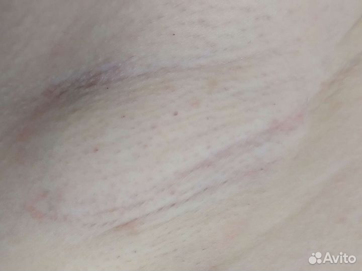 Шугаринг, электроэпиляция, лазерная эпиляция