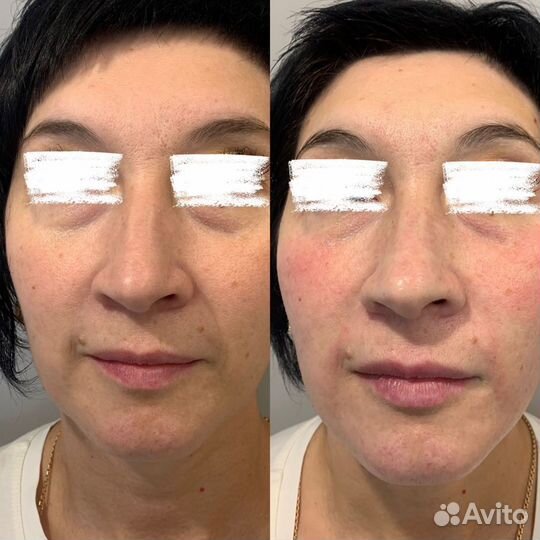 Холодная плазма. Обучение