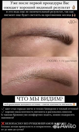 Лазерное удаление тату и татуажа бровей