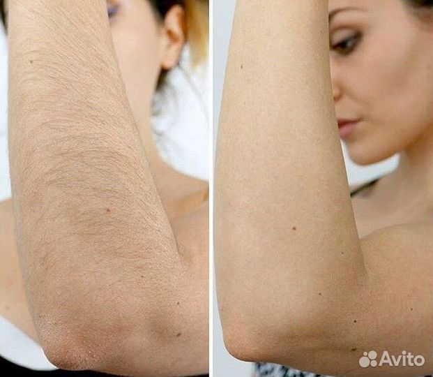 Лазер для удаления татуировок