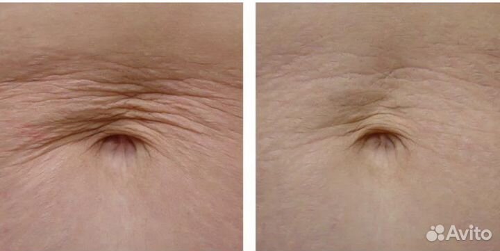 Удаление растяжек живот