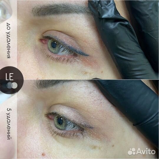 Удаление татуажа/тату на пикосекундном лазере