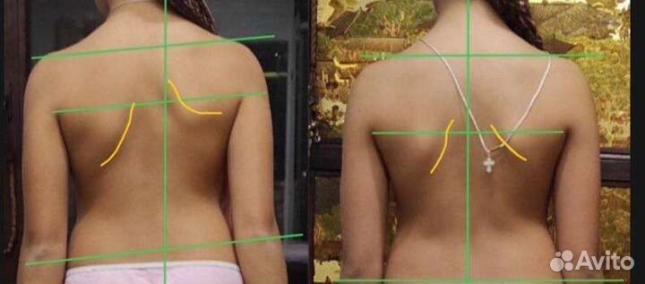 Массаж - реабилитация (оздоровление)