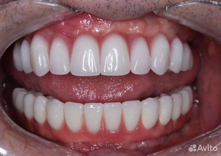 Изготовление съёмного протеза