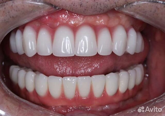 Изготовление съёмного протеза