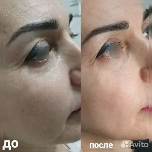 Холодная плазма, Импульсная спрей-коагуляция кожи