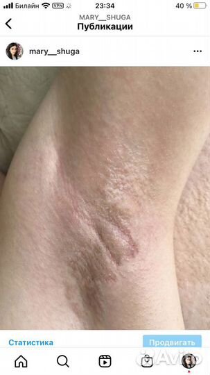 Шугаринг: глубокое бикини