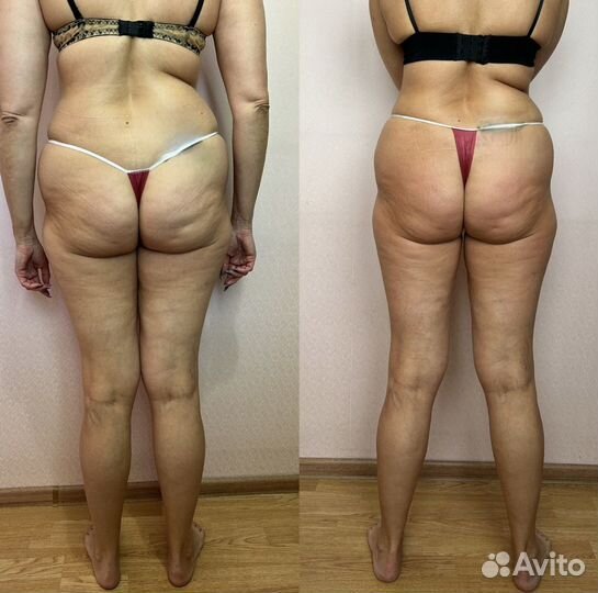 Антицеллюлитный массаж ручной