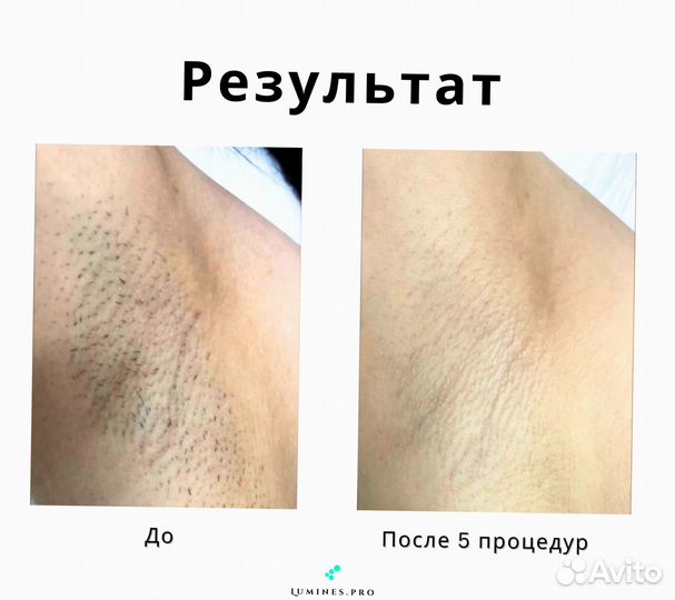 Диодный лазер для эпиляции Люминес. Max’One 1200