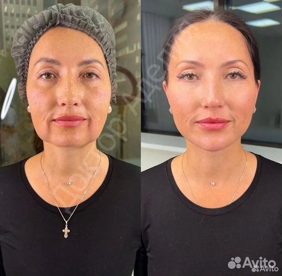 Подтяжка лица за одну процедуру. Альтератерапия