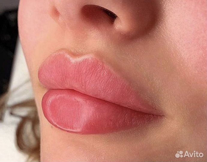 Увеличение губ