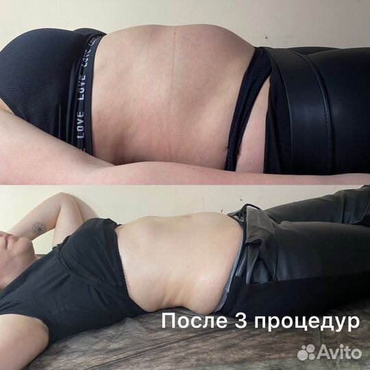 Кавитация, RF лифтинг, вакумный массаж