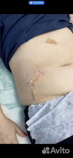 Точка голода, гиперсушка, липолитики