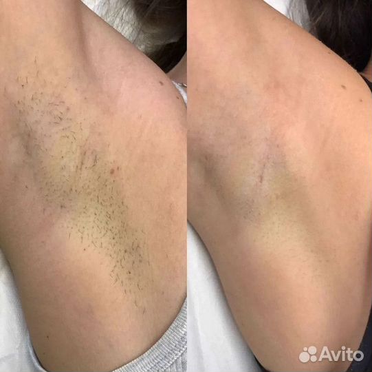 Лазерная эпиляция – стабильный доход с клиентами