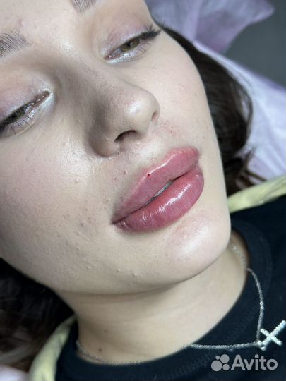Увеличение губ