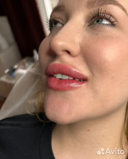 Врач косметолог. Увеличение губ. Ботокс