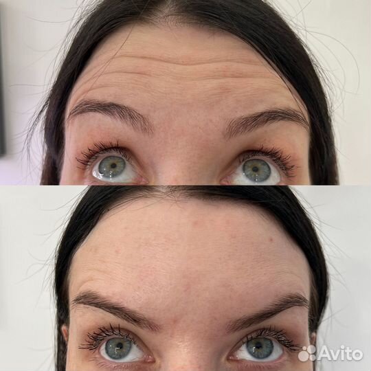 Ботокс для лица