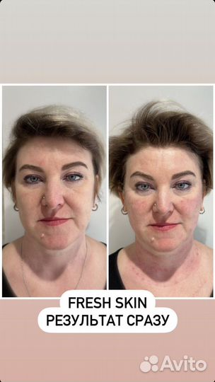 Мезотерапия лица