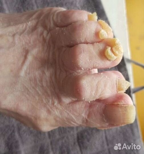 Медицинский педикюр,подолог