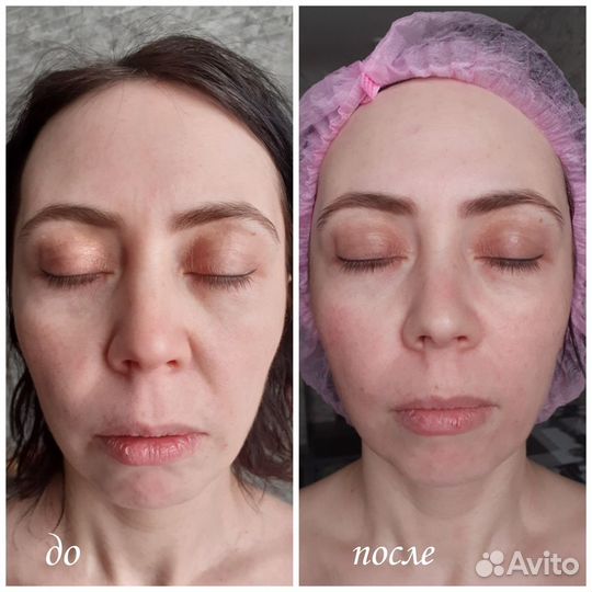 Массаж лечебный, скульптурно-буккальный