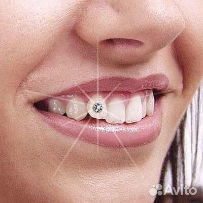 Бриллиант на зуб