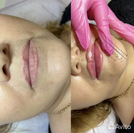 Увеличение губ, увлажнение 0,5мл, 1мл