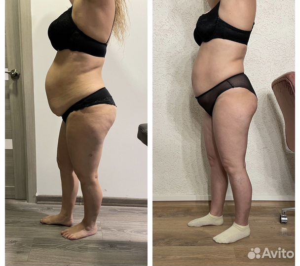 LPG - массаж, кавитация, rf- лифтинг