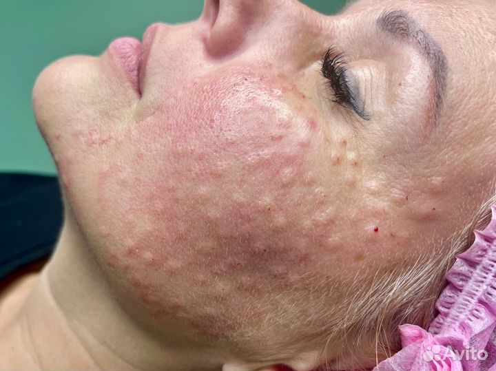 Мезотерапия / Липолитики / Подтяжка кожи