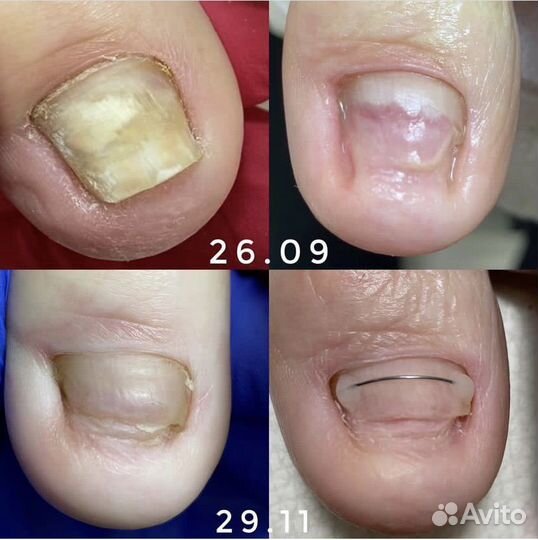 Модели на титановую нить при вросшем ногте