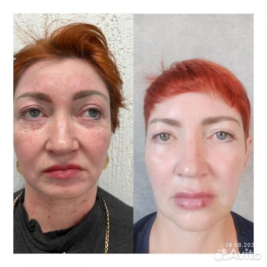 Модель на биоревитализацию лица/ мезонити/Ботокс