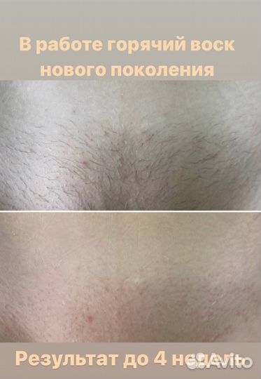 Шугаринг/воск/депиляция