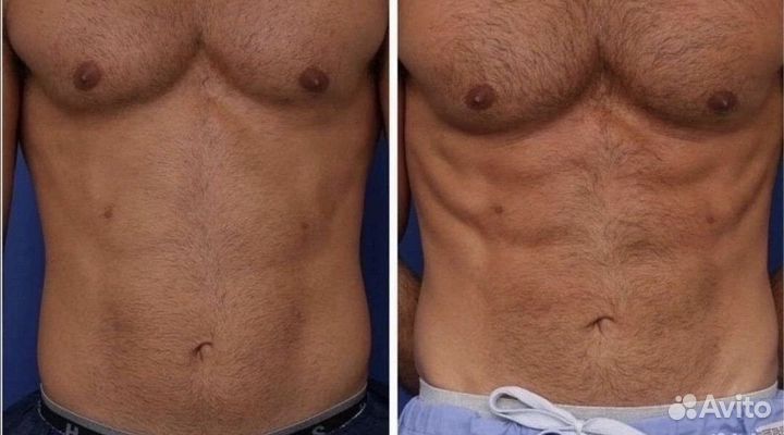 Emsculpt