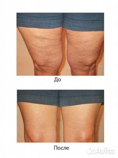 Антицеллюлитная маска скраб для стройности