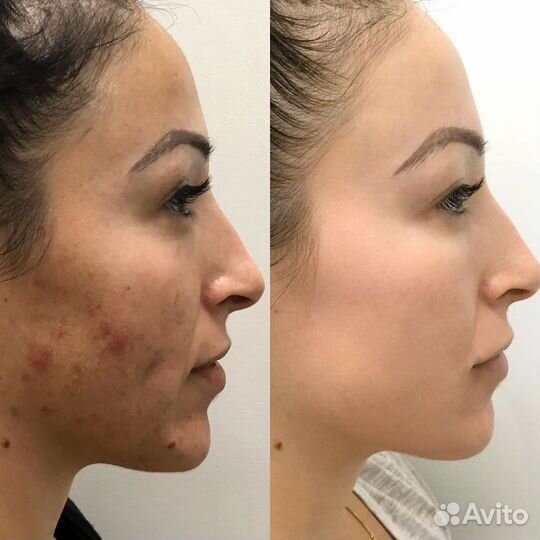 Карбоновый пилинг+лазерное удаление татуажа, тату