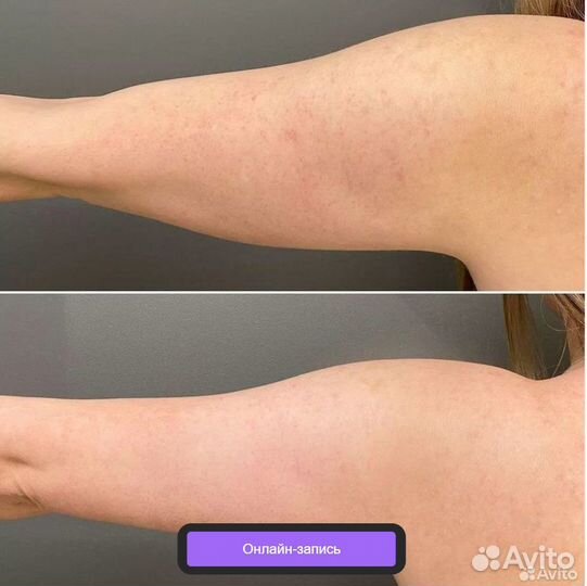 Криолиполиз