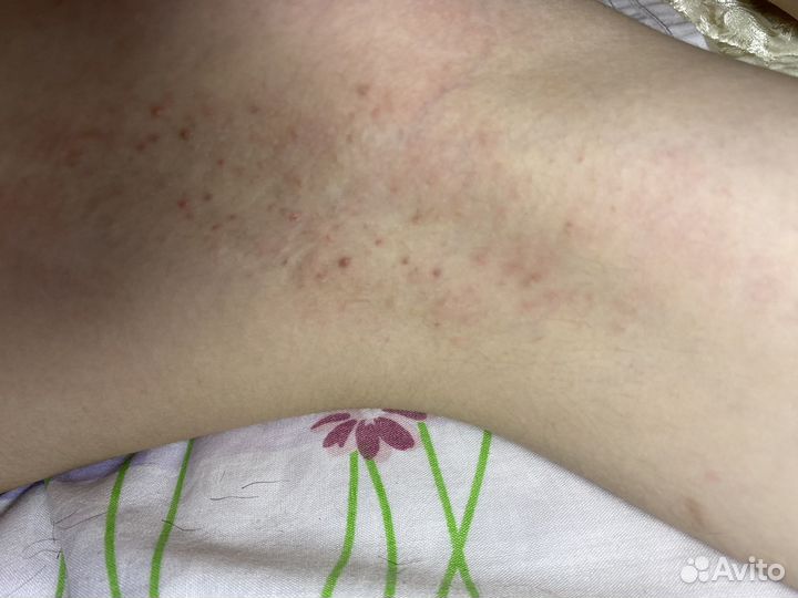 Электроэпиляция