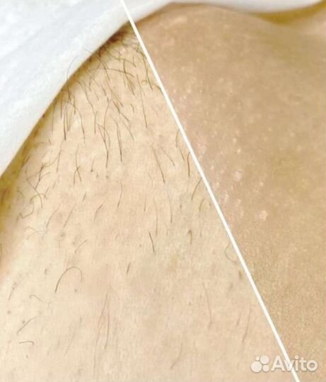 Шугаринг, депиляция