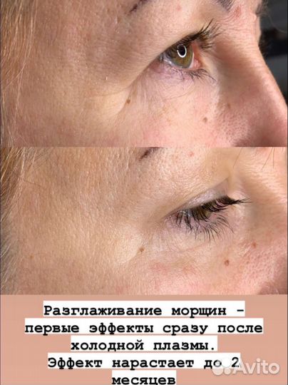 Холодная плазма