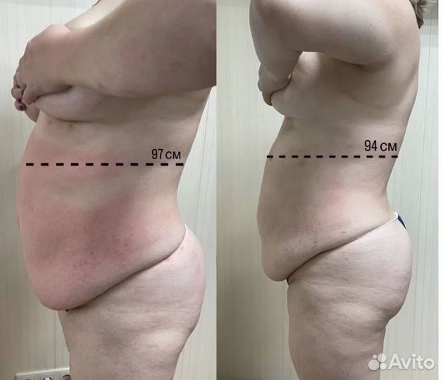 LPG массаж в Перми Оригинальный бразильский LPG