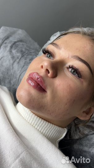 Увеличение губ Аугментация губ