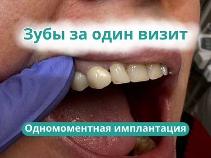 Одномоментная имплантация зубов