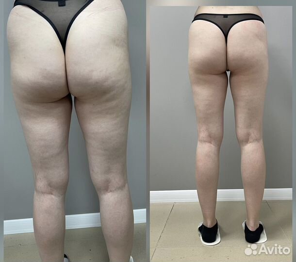 Антицеллюлитный массаж