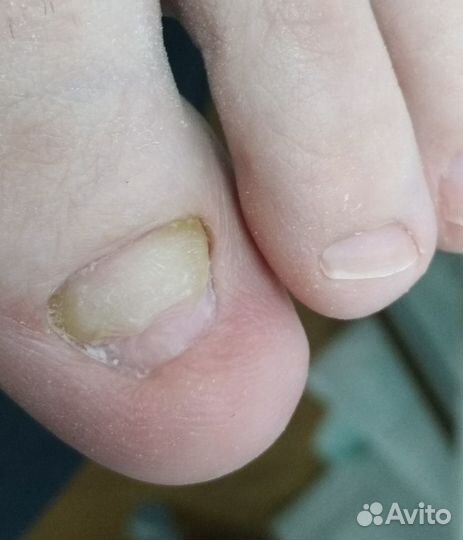 Педикюр(медицинский) Выезд