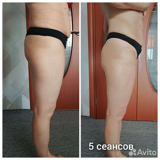 Массаж, похудение, Мадеротерапия