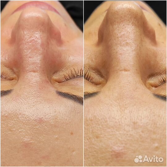 УЗ чистка лица, фонофорез, LED терапия