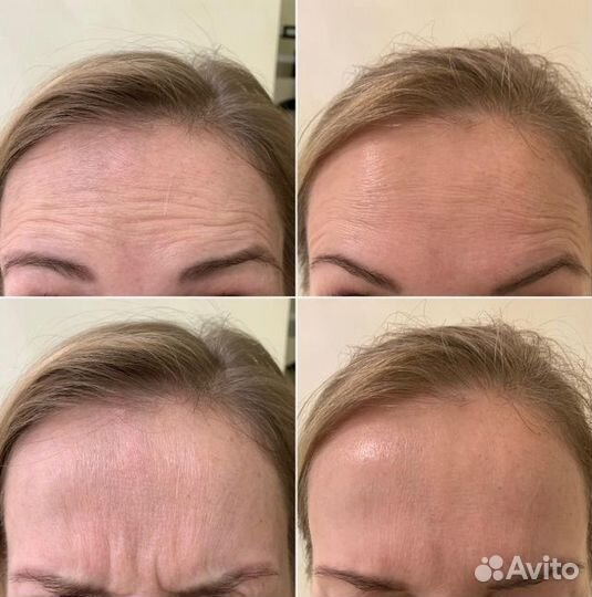 Поиск моделей для процедуры ботокса