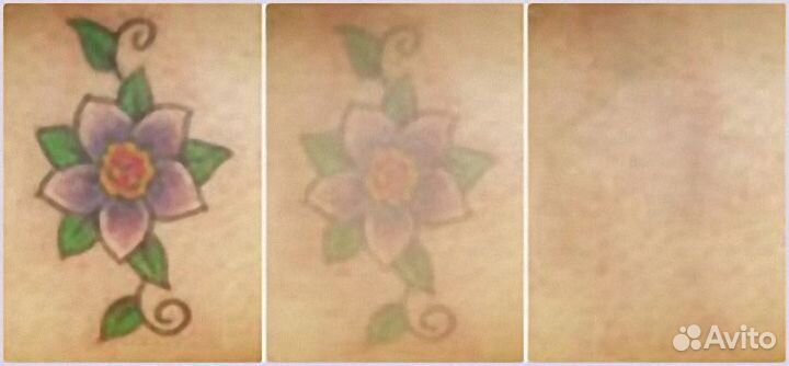 Лазер для удаления тату с обучением