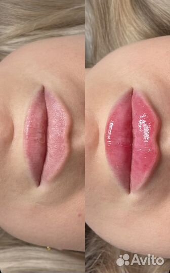 Косметолог, увеличение губ, биоревитализация