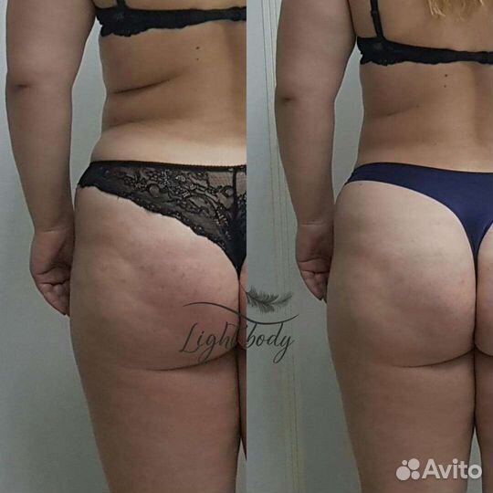 Lpg массаж, Лазерная эпиляция, RF лифтинг и др